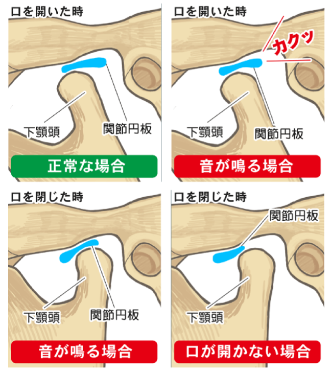 顎関節症の代表的な症状