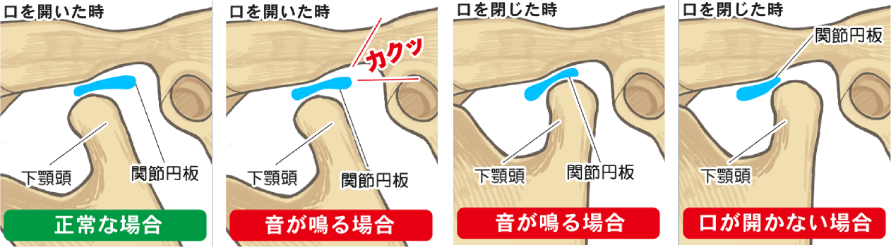 顎関節症の代表的な症状