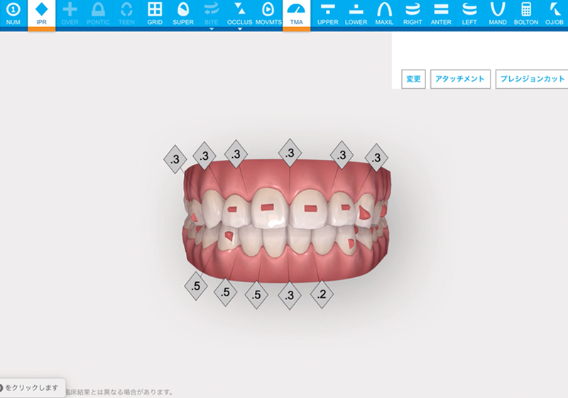 矯正期間と矯正後の歯並びを可視化