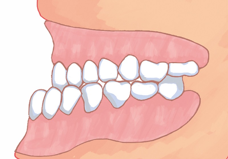 下顎前突反対咬合