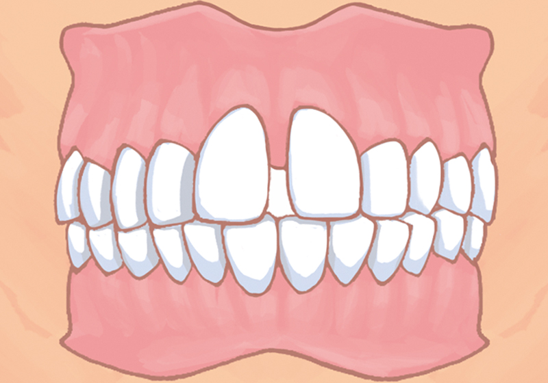 空隙歯列