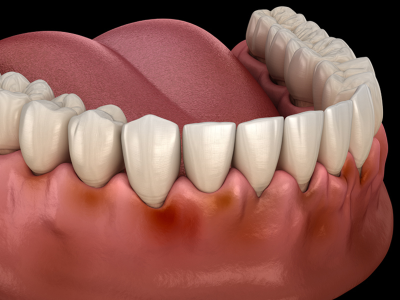 歯周病ってなに？