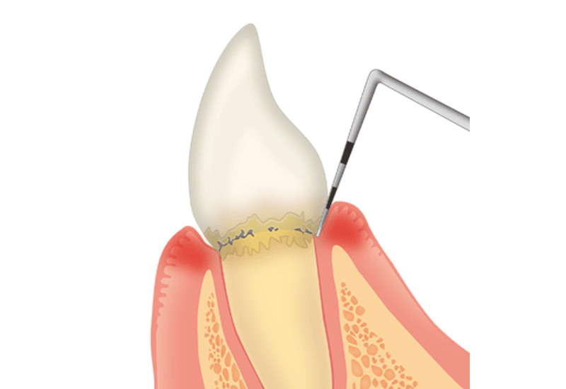歯周ポケット検査