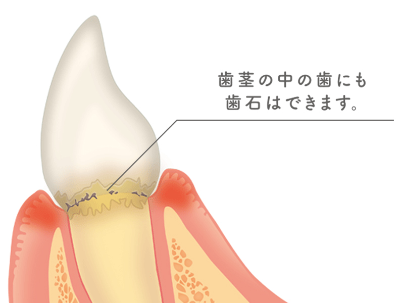 プラーク