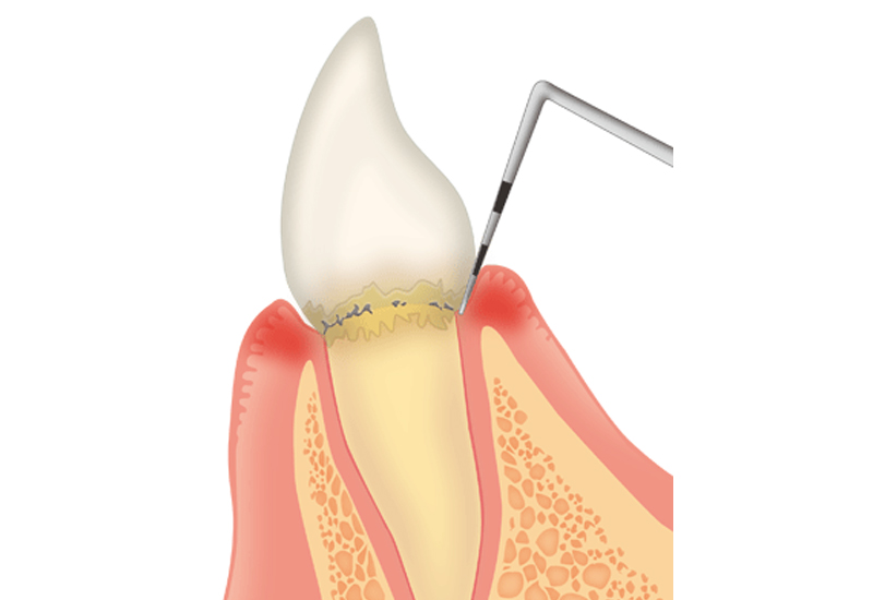 歯周ポケット検査