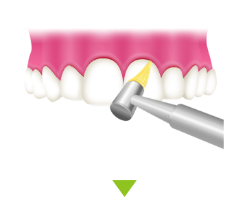 歯と歯の隙間を清掃